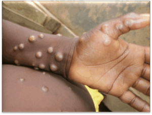 Elevados níveis de alerta em relação à Mpox